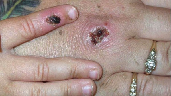 2003年6月5日，美國CDC發布的一張感染猴痘病毒的患者手部圖片。（圖片來源：CDC/Getty Images）