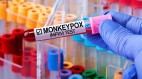 關於「猴痘」你該知道這些事(組圖)