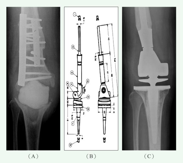 患者的膝关节周围骨骼严重损坏（Ａ），以至于无法适配三种常见的人工关节模组，在与工程师进行了充分沟通后，决定设计并定制一款长柄型人工关节（Ｂ），从而大大提升了治疗的成功率和患者的生活品质（Ｃ）。