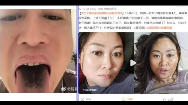 天津男子確診後，發現舌頭、牙齒都變黑。（左）；安徽女子確診第4天，滿臉變得黑糊，如同被毀容（右）。