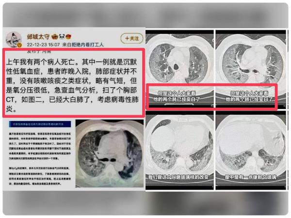 中国原始新冠毒株重现 医护曝恐怖“白肺”照片
