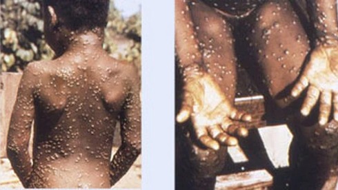 图为1970年刚果民主共和国所发现的猴痘确诊病例，其为目前所知最早的人类感染病例。