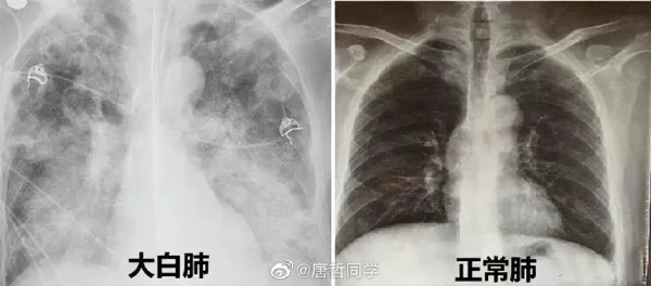 白肺