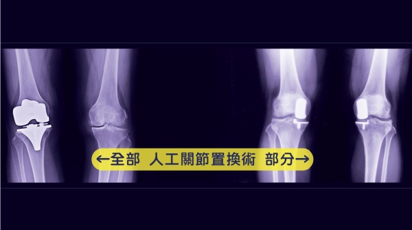 人工膝关节置换图。