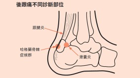 「後跟痛」等於「足跟痛」治療方式差很大(圖)